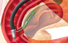 �����޵�Į, ERCP Guide Wire ��TRU WIRE�� ���� Ȯ�롦 500���޷� �Ը� ���� ��ǥ